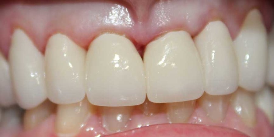 The same teeth after treatment, with even edges, matched colour and a level gum line.