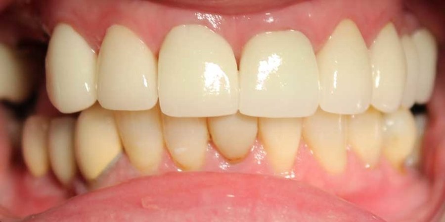The same teeth after treatment, uniform in shade with restored edges.