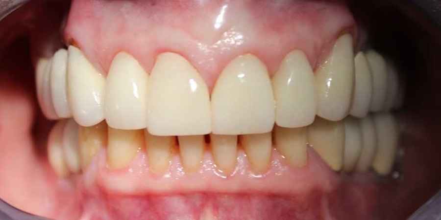 The same front teeth after treatment, aligned evenly across the arch.