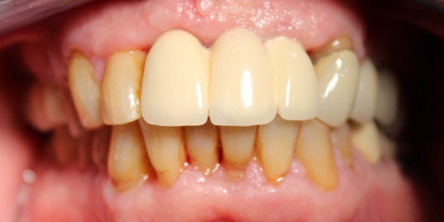 The same arch after restoration, with crowns fitted over the implants.