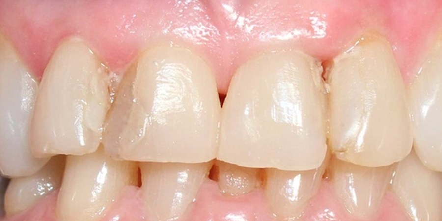 Close-up of a patient’s upper front teeth before treatment, showing chipped edges, staining and uneven length.