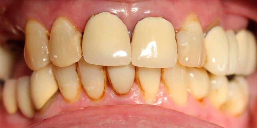 Upper and lower front teeth before treatment, with brown staining near the gums and worn, uneven edges.