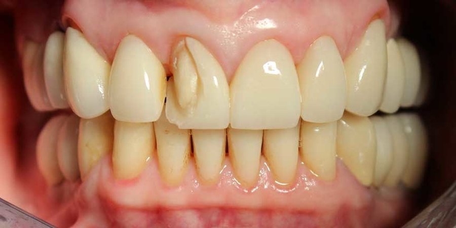 Front teeth before treatment, with one upper incisor rotated and set back behind the others.