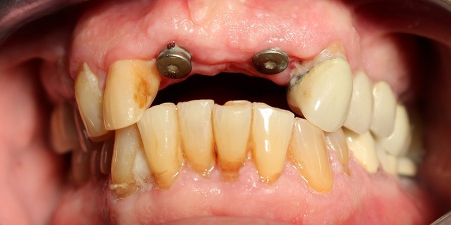 An upper arch before restoration, showing two exposed metal implant abutments and missing teeth.